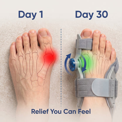 Novuva Bunion Corrector
